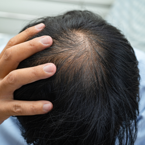 Behandlung von Haarausfall (Alopecia):​